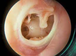 How do i know if i ruptured my eardrum or broke any of my ? Ruptured Eardrum Symptoms Causes And Treatments