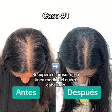 Caida De Cabello Antes Y Despues | TikTok