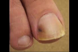 Skin cancer is the most common type of cancer in the united states by a pretty large margin, and it does not discriminate. Dermdx Pigmented Toe Nail With No Reported Trauma Dermatology Advisor