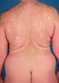 The exact cause that is responsible for causing lesions is not known. Erythematose Papulonodose Und Erythematosquamose Erkrankungen Springerlink
