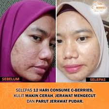Ini cara paling cepat nak dapatkan laporan ccris. Promo 4 2 Sysfel C Berries C Berries Cberries Cberry Sysfel Vitamin C Collagen Astaxanthin Cerah Gebu Shopee Malaysia