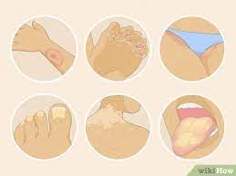 3 Ways To Treat Fungal Rash - Wikihow