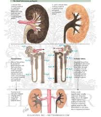 Image result for Intravenous Pyelogram