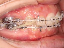 スタッフブログ⑨〜ワイヤー治療開始から1年3ヶ月〜 | 福岡天神矯正歯科