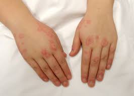 Systemic Mastocytosis - Ask Hematologist | Understand Hematology
