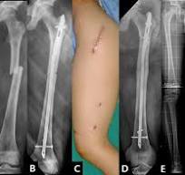 Intramedullary nailing versus submuscular plating in ...