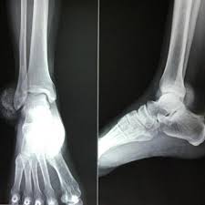 We discussed the risks of surgery including, but not limited to: Primary Synovial Osteochondromatosis Of Ankle In An Adult Male Patient Eurorad