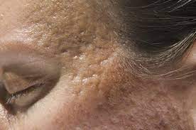 How Do I Get Rid Of Acne Craters In The Face?