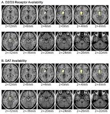 Adhd brains have low levels of a neurotransmitter called norepinephrine. Deficits In Brain S Reward System Observed In Adhd Patients Bnl Newsroom