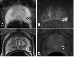 Have shown that the majority of prostate cancer originates in the peripheral zone (pz, at the prostate posterior periphery), as opposed to the transition zone (tz, in the central anterior. Multiparametric Mri Versus Multiparametric Us In The Detection Of Prostate Cancer Anticancer Research
