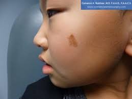 Birthmarks Removal Before and After Photos • Dr. Cameron Rokhsar