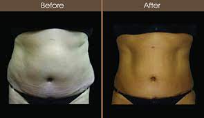 The number one similarity between the two is that they both help in fat reduction. Laser Liposuction New York Smart Lipo Ny