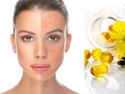 This oil will bring a lot of benefits to your skin, hair, and health if used regularly. 9 Phenomenal Benefits Of Evening Primrose Oil For Skin Oils We Love