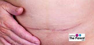 C Section Scar Care For Quick Healing And Recovery Being The Parent