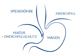 Zwerchfellbruch Hiatushernie Antireflux Info