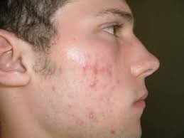 Cara menghilangkan jerawat di badan. Cara Menghilangkan Jerawat Secara Alami Halaman All Kompasiana Com
