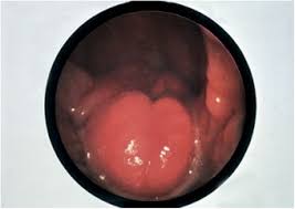 Image result for Reflux Laryngitis