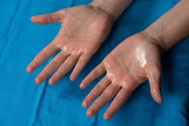 Image result for Hyperhidrosis Causes