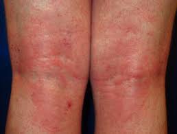 It's a treatment for a number of different types of cancer. Methotrexate Dermnet Nz