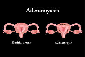 Adenomyosis and endometriosis are all caused by endometriosis growth. Adenomyosis Treatments