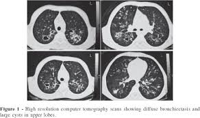 Cystic fibrosis | care guidelines for nutrition management. Cystic Fibrosis With Normal Sweat Chloride Concentration Case Report