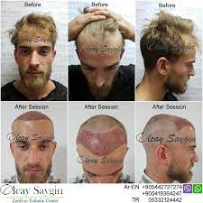 Best Hair Transplant Doctor In Turkey Hair Transplant Best Hair Transplant Hair Transplant Surgery