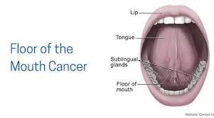 When person or persons suffers from mouth cancer, the cancer may be affecting any part of their mouth. Floor Of The Mouth Cancer