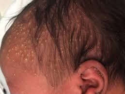 Die transitorische neonatale pustulose oder transitorische pustulöse melanose verläuft ebenfalls selbstlimitierend; Transient Neonatal Pustular Melanosis Dermnet Nz