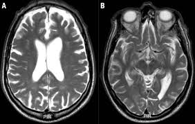 Cte was previously known as punch drunk syndrome and dementia pugilistica. Scielo Brasil Extending The Range Of Differential Diagnosis Of Chronic Traumatic Encephalopathy Of The Boxer Insights From A Case Report Extending The Range Of Differential Diagnosis Of Chronic Traumatic Encephalopathy
