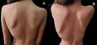 Image result for Winged Scapula