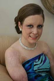 Phoenix Society for Burn Survivors