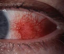 Image result for Scleritis