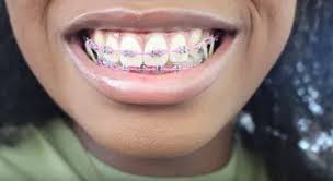 Adored by fashion fans and value seekers alike. Choose The Best Colors For Your Braces 2021 Good Colors Ideas