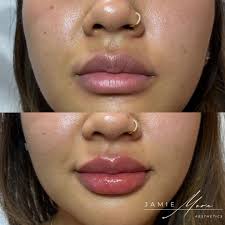 Plump up your pout just in time for summer! 💋 💉 📆 Schedule your lip  filler appointment with Jamie Mora, PA-C @Studiophilly Instagram: link in  bio 📱 267-586-4978 Hablo Español 🇨🇴 Pricing: