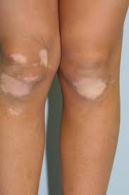 Ils optent pour le changement de la couleur de peau : Dermato Info Le Vitiligo