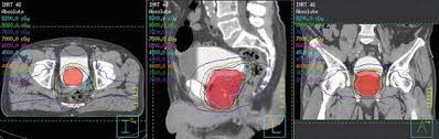 Find out what it is, how you have it and what happens afterwards. Multi Atlas Based Segmentation Of Pelvic Structures From Ct Scans For Planning In Prostate Cancer Radiotherapy Springerlink