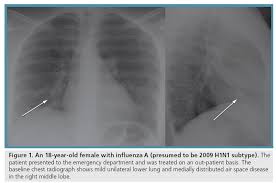 Aviram said the study's findings can help physicians better. Imaging Swine Flu Is It Ever Necessary