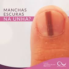 Na maior parte dos casos de onicomicose atinge unhas placa em pé, por isso a doença é visto de uma vez, mas já na fase expressas sintomas. Dermatologista Especialista Em Unhas Dra Ana Carulina Moreno
