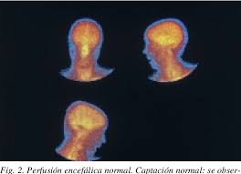 Hemisphere deconnection and unity in conscious awareness, amer. Medicina Nuclear Y Diagnostico De Muerte Encefalica Angiogammagrafia Cerebral Con Tc99m Hmpao Sensibilidad Y Especificidad Diagnostica Semantic Scholar