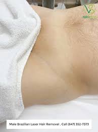 We did not find results for: Brazilian Laser Hair Removal For Men Vs Medspa Laser Clinic