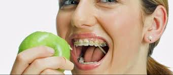 In addition, it is recommended to eat soft foods that need minimal effort to chew, such as: Food Lover S Guide Which Foods Are Safe With Braces In The Cove
