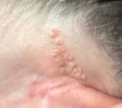 Image result for Linear Dermatitis