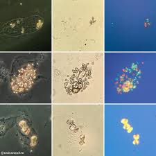 Caoxalate Monohydrate Whewellit Crystals Within Hyaline Casts A Couple Of Days After Severe Ethylene Glycol Intoxication Phase Crystals Medical Tech Urinal