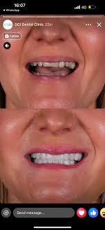 I'm very happy with my new smile & my experience 🤩