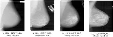 A Classification Framework For Prediction Of Breast Density