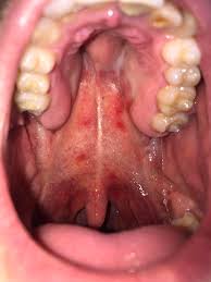 Image result for Physical injury red spots roof of mouth