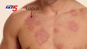 It's an autoimmune disease, which means that your immune system — the body system that usually. Causes Symptoms Treatments For Lupus Disease Star Hospitals Health File Tv5 News Youtube