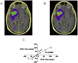 Brain tumors can occur at any age. Plos One A Novel Method For Volumetric Mri Response Assessment Of Enhancing Brain Tumors