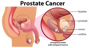 In theory, prostate cancer cells can spread anywhere in the body. What Is Prostate Cancer The Walnut Foundation