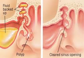 Nasal polyps are soft, painless, noncancerous growths on the lining of your nasal passages or sinuses. Nasal Polyps Guide Causes Symptoms And Treatment Options